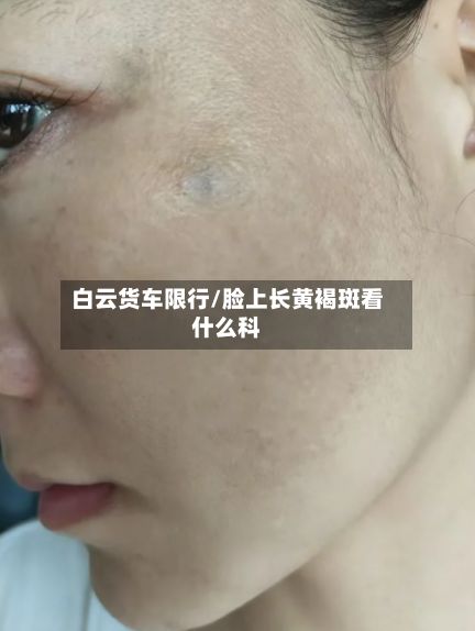 白云货车限行/脸上长黄褐斑看什么科