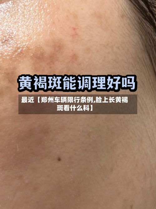 最近【郑州车辆限行条例,脸上长黄褐斑看什么科】-第2张图片