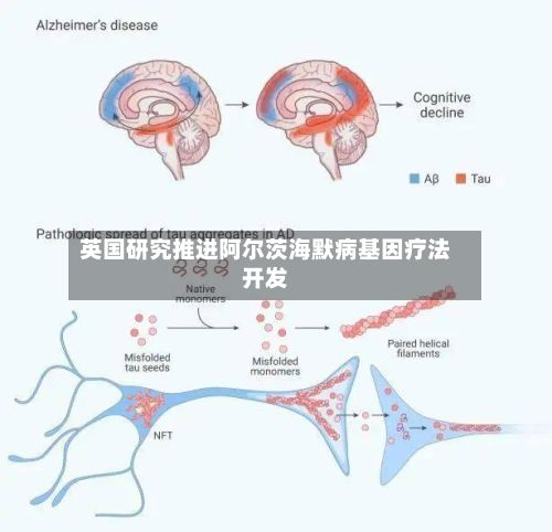 英国研究推进阿尔茨海默病基因疗法开发