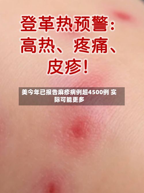 美今年已报告麻疹病例超4500例 实际可能更多