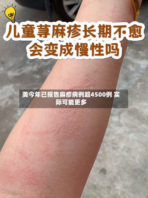 美今年已报告麻疹病例超4500例 实际可能更多-第2张图片
